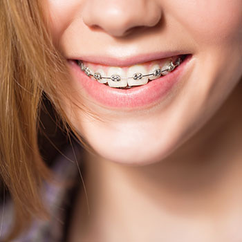 metal braces