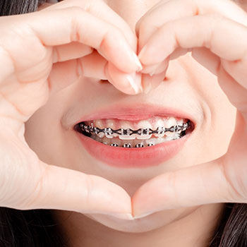 Close Up Lover Dental Braces